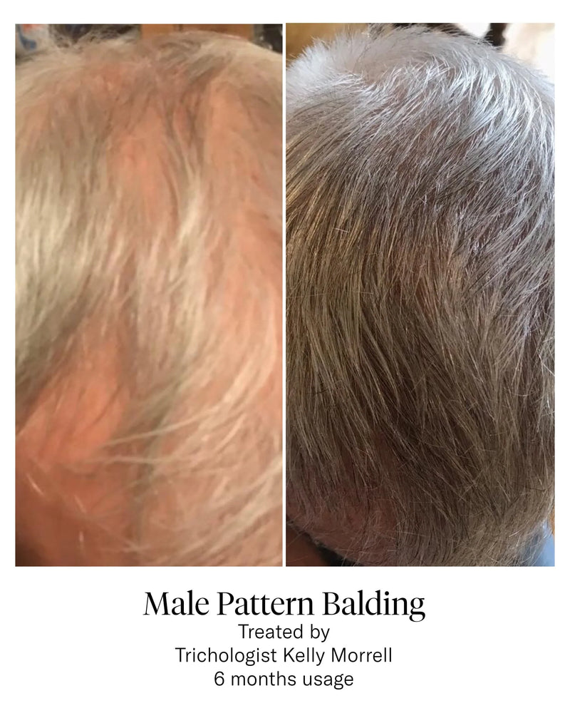 Advanced Hair System Kit | 1 box of 6 bottle | Calecim